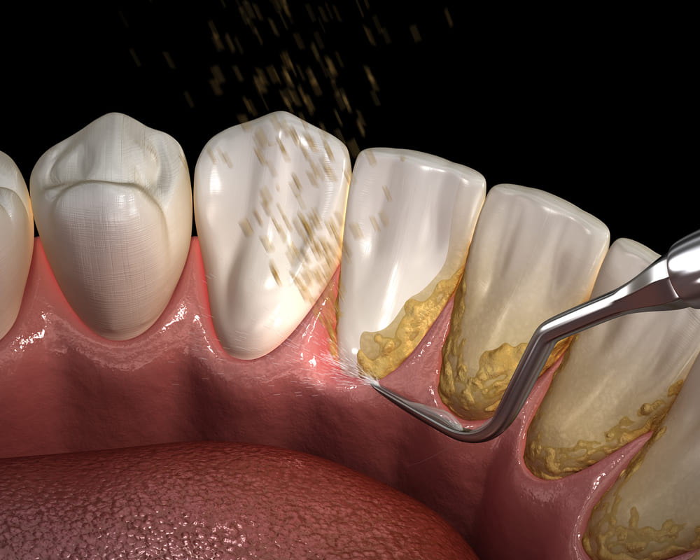 periodoncia